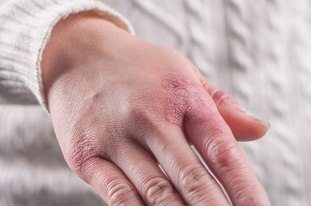 Chilblains
